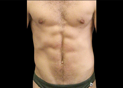 2 After Emsculpt PIC 105 after abdomen male Ryan Neinstein MD 6TX 412x296px