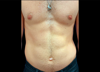 2 Before Emsculpt PIC 105 before abdomen male Ryan Neinstein MD 412x296px