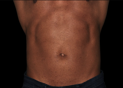 3 After Emsculpt PIC 053 After abdomen male Suneel Chilukuri MD 12W 4TX 412x296px