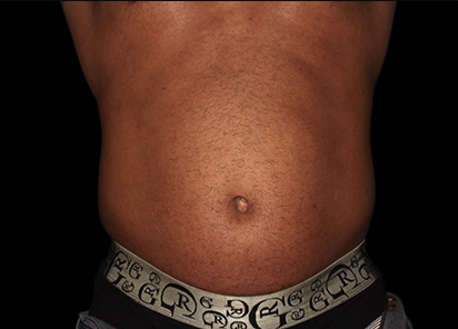 3 Before Emsculpt PIC 053 Before abdomen male Suneel Chilukuri MD 412x296px