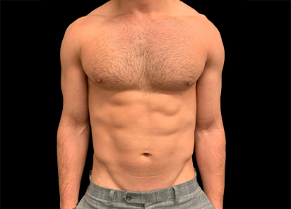 4 After Emsculpt PIC 108 after abdomen male Arash Akhavan MD 4TX 412x296px