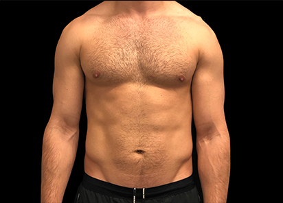 4 Before Emsculpt PIC 108 before abdomen male Arash Akhavan MD 412x296px