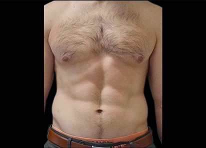 5 After Emsculpt PIC 073 After abdomen male Weiler Plastic Surgery 1W 4TX 412x296px