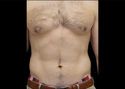 5 Before Emsculpt PIC 073 Before abdomen male Weiler Plastic Surgery 412x296px