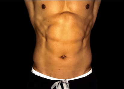 6 After Emsculpt PIC 059 After abdomen male Siamak Agha MD 4TX 412x296px