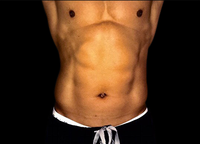 6 Before Emsculpt PIC 059 Before abdomen male Siamak Agha MD 412x296px