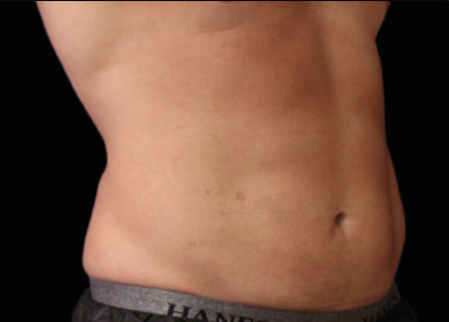 7 After Emsculpt PIC 060 After abdomen male Richard Goldfarb MD 4TX 412x296px