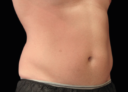 7 Before Emsculpt PIC 060 Before abdomen male Richard Goldfarb MD 4TX 412x296px