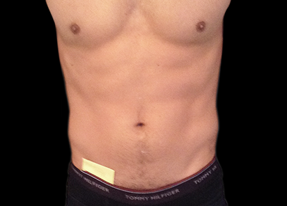 8 After Emsculpt PIC 013 After abdomen male Anita Sturnham MD 412x296px