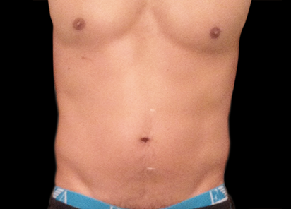 8 Before Emsculpt PIC 013 Before abdomen male Anita Sturnham MD 412x296px