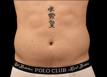 9 After Emsculpt PIC 028 After abdomen male Paula Lozanova MD 4TX 412x296px