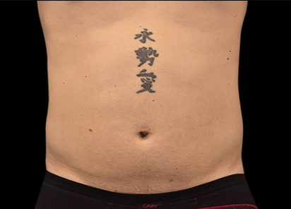 9 Before Emsculpt PIC 028 Before abdomen male Paula Lozanova MD 4TX 412x296px