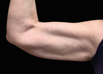 1 After Emsculpt PIC 122 after arms female Winston Salem Dermatology   Surgery Center 2M 412x296px
