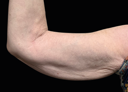 1 Before Emsculpt PIC 122 before arms female Winston Salem Dermatology   Surgery Center 412x296px
