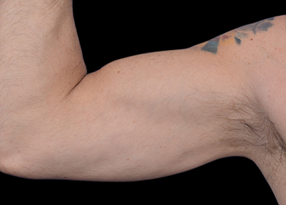 3 After Emsculpt PIC 098 after biceps male Barry DiBernardo MD 4TX 412x296px