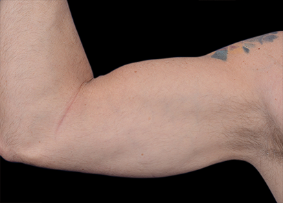 3 Before Emsculpt PIC 098 before biceps male Barry DiBernardo MD 4TX 412x296
