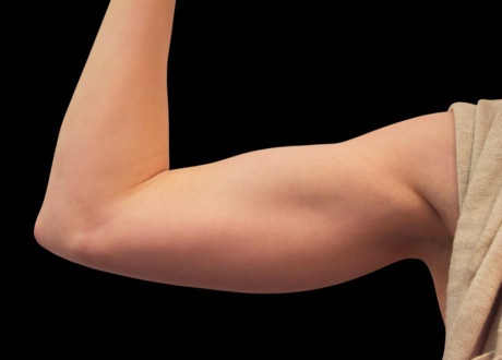 4 After Emsculpt PIC 078 After biceps female Reminder Saluja MD md 4TX 825x592