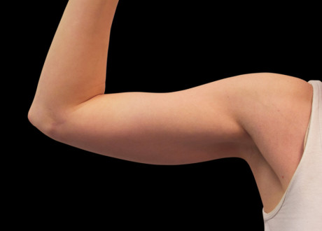 4 Before Emsculpt PIC 078 Before biceps female Reminder Saluja MD md 4TX 825x592