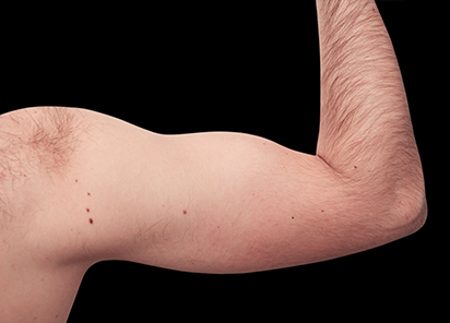 5 After Emsculpt PIC 079 after biceps male Reminder Saluja MD 4TX 412x296