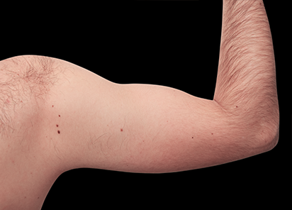 5 Before Emsculpt PIC 079 before biceps male Reminder Saluja MD 4TX 412x296