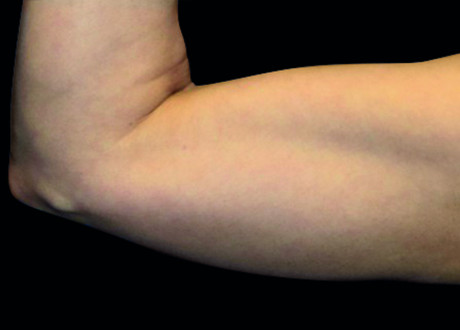 6 After Emsculpt PIC 075 After arms female Reminder Saluja MD 3W 4TX