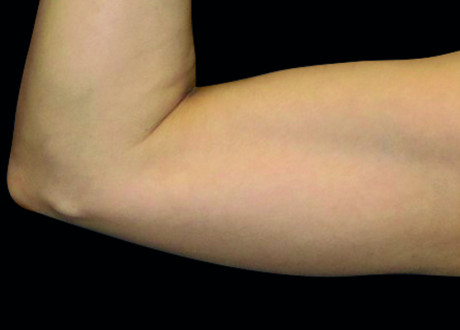 6 Before Emsculpt PIC 075 Before arms female Reminder Saluja MD