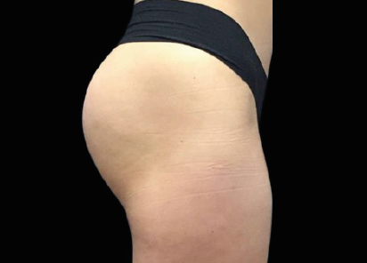1 After Emsculpt PIC 094 After buttock female Seaside Aesthetics 8W 4TX  412x296px