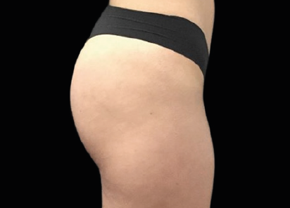 1 Before Emsculpt PIC 094 Before buttock female Seaside Aesthetics  412x296px