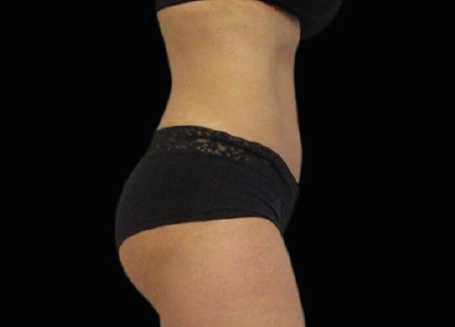 2 Emsculpt PIC 093 After abdomen female Michaela Persky MD 412x296px