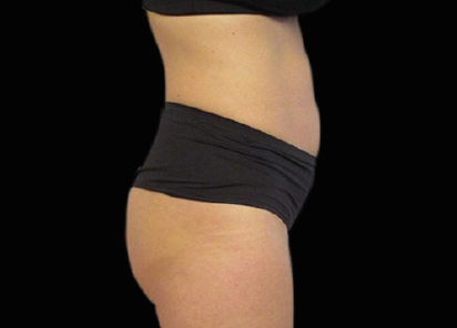 2 Emsculpt PIC 093 Before abdomen female Michaela Persky MD 412x296px