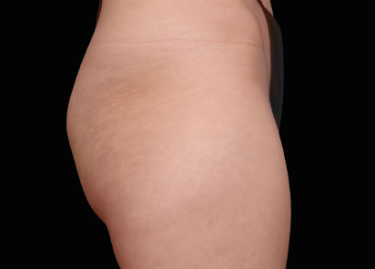 3 Before Emsculpt PIC 049 Before buttock female Lasky Aesthetics  412x296px