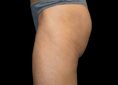 4 Before Emsculpt PIC 045 Before buttock female Alain Michon MD 412x296px