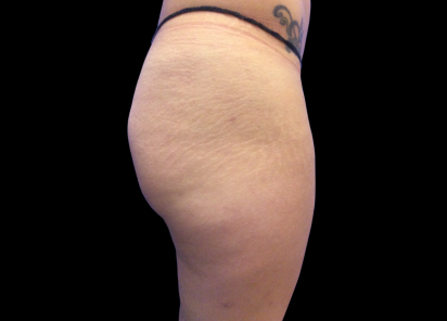 5 After Emsculpt PIC 017 After buttock female Carolyn Jacob MD 4TX 412x296px