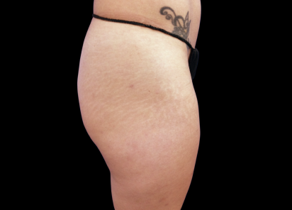 5 Before Emsculpt PIC 017 Before buttock female Carolyn Jacob MD 412x296px