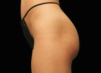 7 Before Emsculpt PIC 021 Before buttock female Brian Kinney MD 412x296px