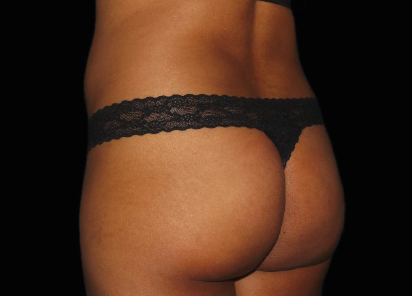 9 Before Emsculpt PIC 036 Before buttock female Chris Bailey Ovation Med Spa  412x296px