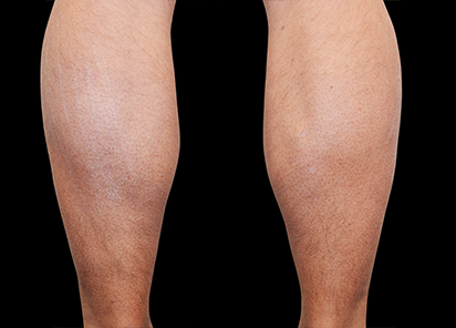 1 After Emsculpt PIC 082 After calves male Reminder Saluja MD 4TX 412x296