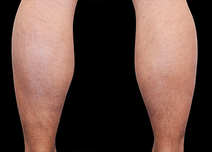 1 Before Emsculpt PIC 082 Before calves male Reminder Saluja MD 412x296