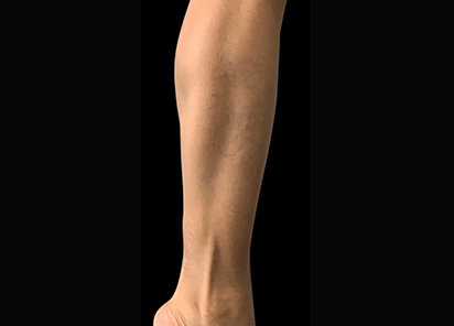 3 After Emsculpt PIC 087 After calves female Reminder Saluja MD 4W 4TX 412x296px