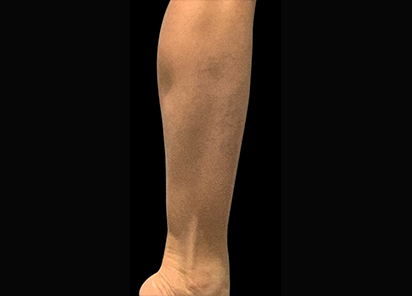 3 Before Emsculpt PIC 087 Before calves female Reminder Saluja MD 412x296px