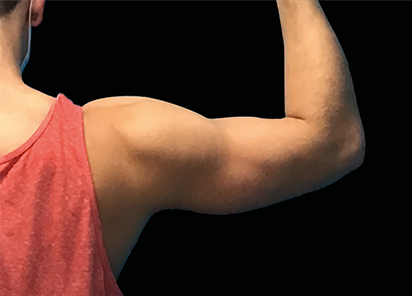 Emsculpt Neo PIC 077 After male arms Carolyn Jacob MD