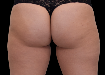 1 After Emsculpt Neo PIC 061 after buttock female BTL Aesthetics 1M 412x296px