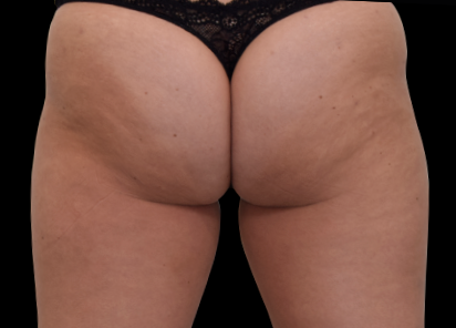 1 Before Emsculpt Neo PIC 061 before buttock female BTL Aesthetics 412x296px