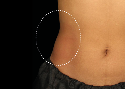 6 Emsculpt Neo PIC 151 after lateral abdomen female Younghoon Cho MD 412x296px
