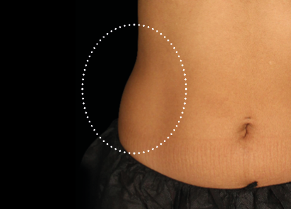 6 Emsculpt Neo PIC 151 before lateral abdomen female Younghoon Cho MD 412x296px