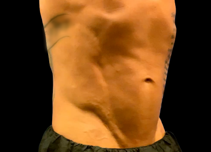 Emsculpt Neo PIC 123 after lateral abdomen male JD McCoy NMD  412x296px