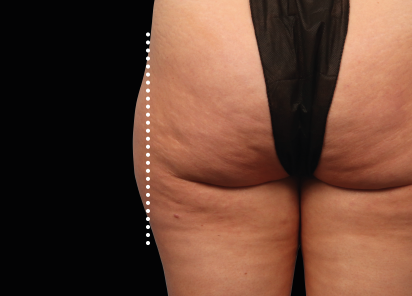 4 After Emsculpt Neo PIC 53 after outer thighs female Melanie Palm MD 412x296px