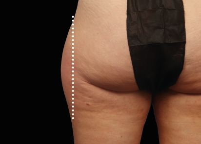 4 Before Emsculpt Neo PIC 53 before outer thighs female Melanie Palm MD 412x296px