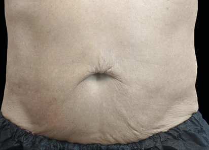 Exion PIC Ba card abdomen male 019 Body ENUS100 AFTER Body