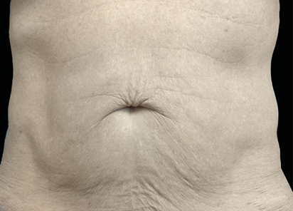 Exion PIC Ba card abdomen male 019 Body ENUS100 BEFORE Body